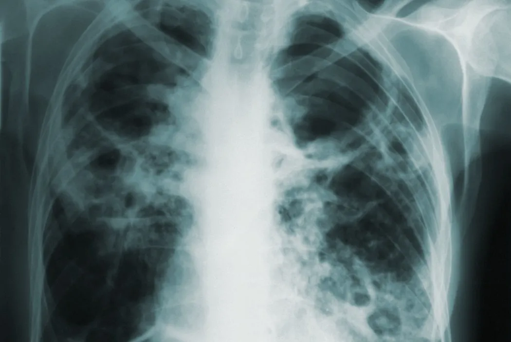 Image of chest X rays